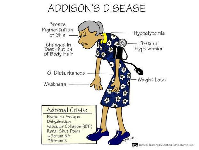 Clinical Features of Addison's Disease