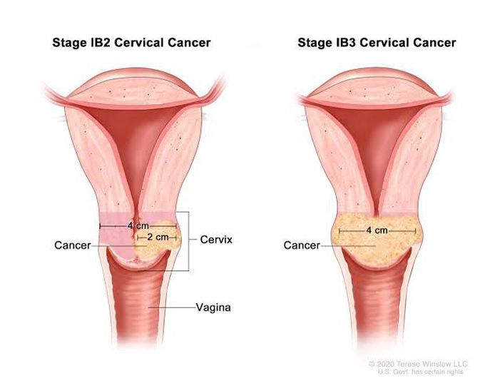Cervical cancer treatment