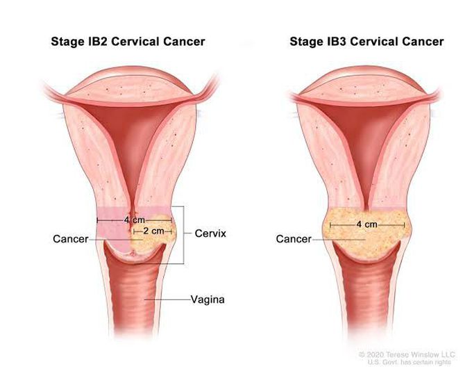 Cervical cancer treatment