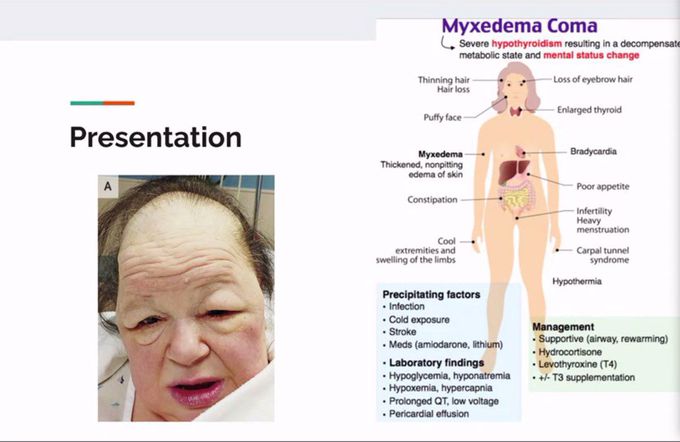 Myxedema Coma - Medical Emergency in Hypothyroidism