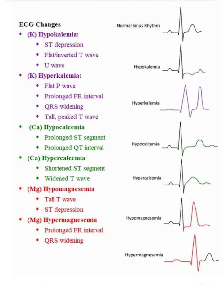 Electrolytes Affecting the ECG MEDizzy