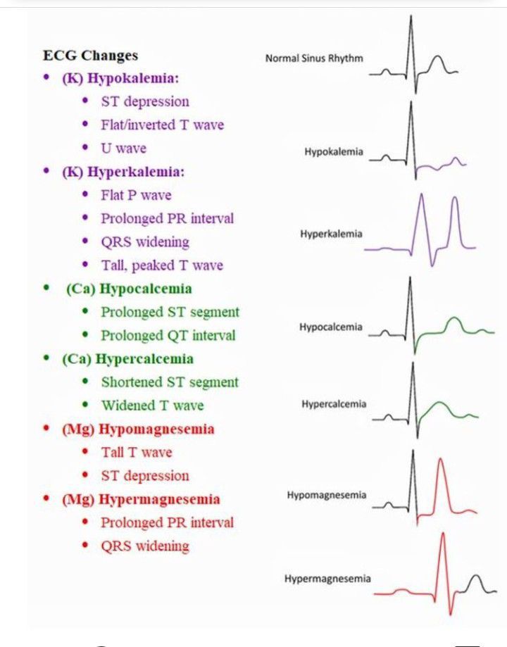 Electrolytes Affecting The ECG - MEDizzy