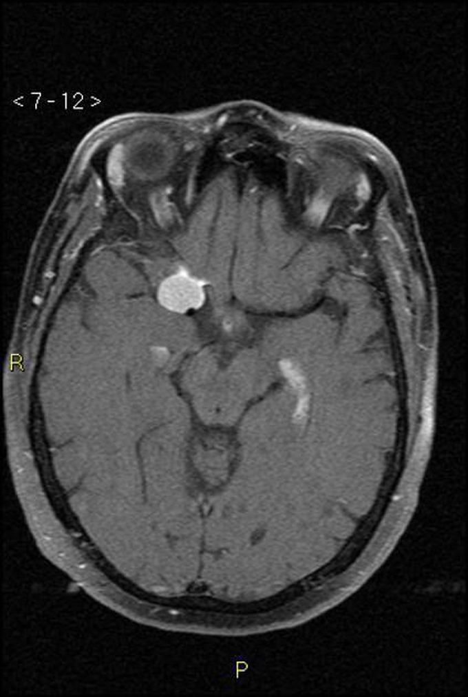 Clinoidal meningiomas