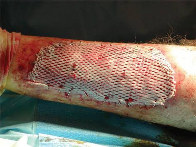 Skin Graft