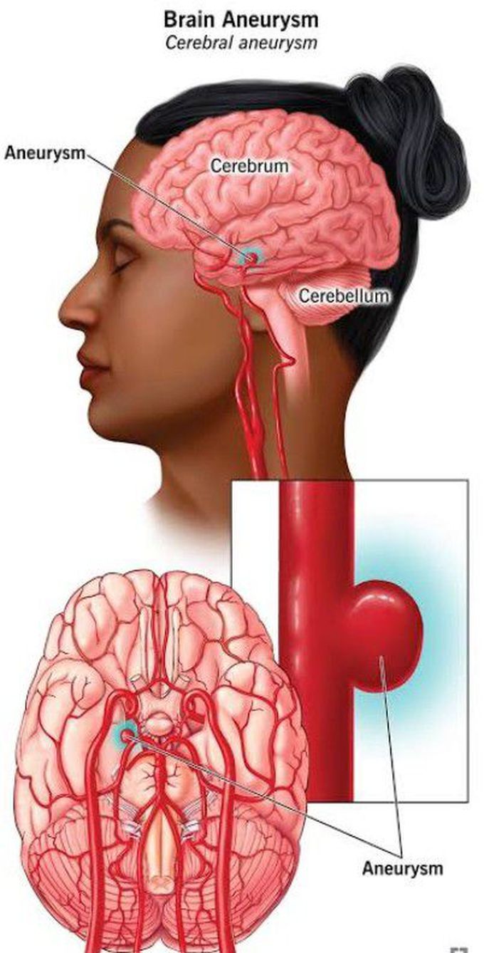 Symptoms of Brain Aneurysm