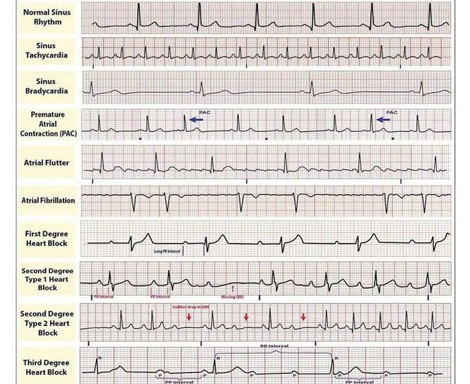 Common Heart Rhythms MEDizzy