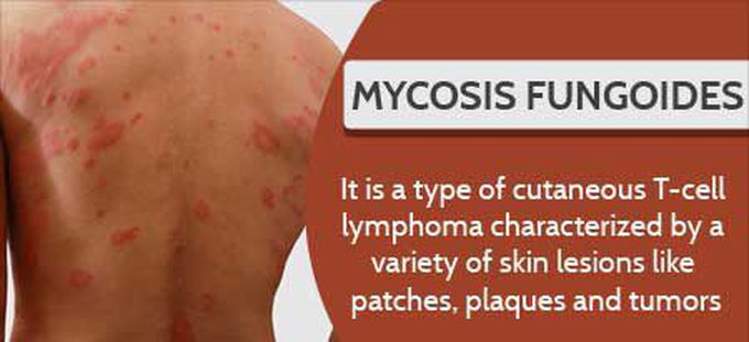 Cause of Mycosis