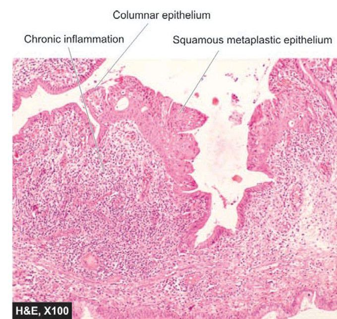 Squamous metaplasia of the uterine cervix.