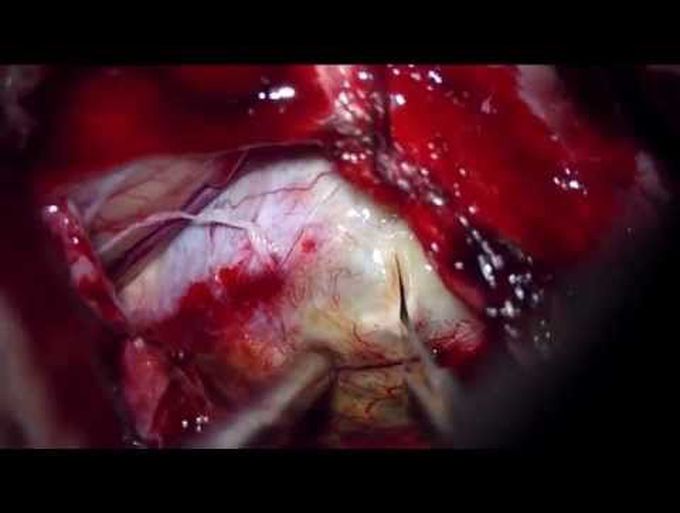 Clipping of a partially thrombosed giant VA aneurysm