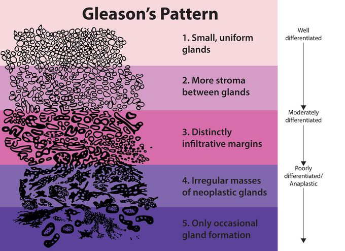 Gleason score