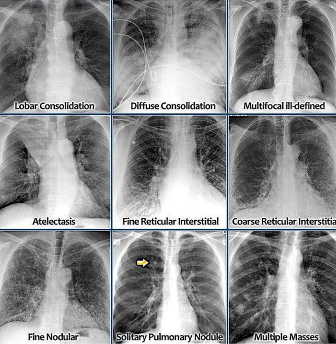 CHEST X-RAY INTERPRETATION