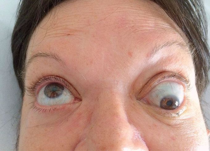 A 60-year-old woman presented to the emergency department with a 2-month history of blurry vision in her left eye. Her medical history was notable for breast cancer treated 3 years earlier with lumpectomy, axillary-node dissection, radiation, and hormonal therapy. Physical exam on upward gaze is demonstrated. What is the diagnosis?