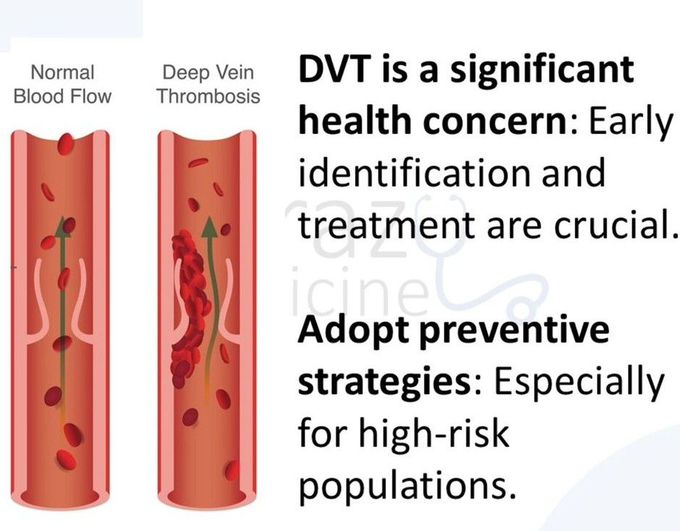 Deep Vein Thrombosis IX