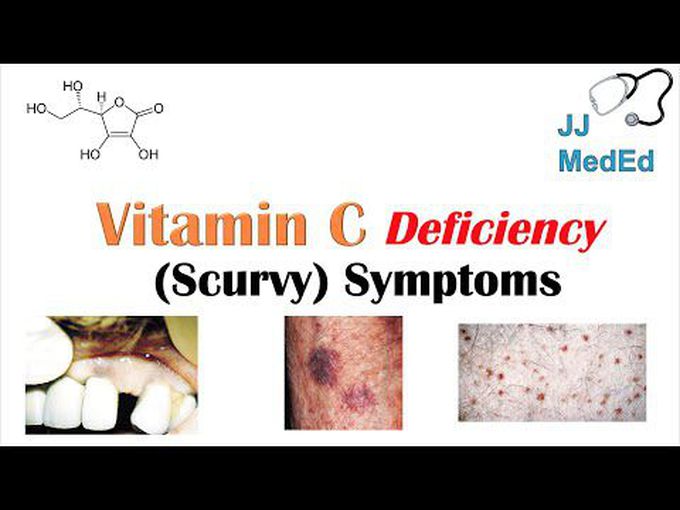 Deficiency of Vitamin C/Scurvy