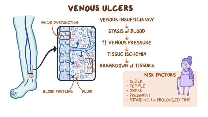 Risk Factor's (Venous leg ulcer )