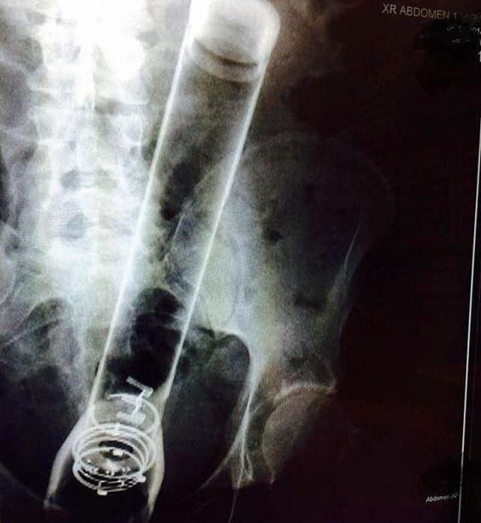 Foreign body in rectum 