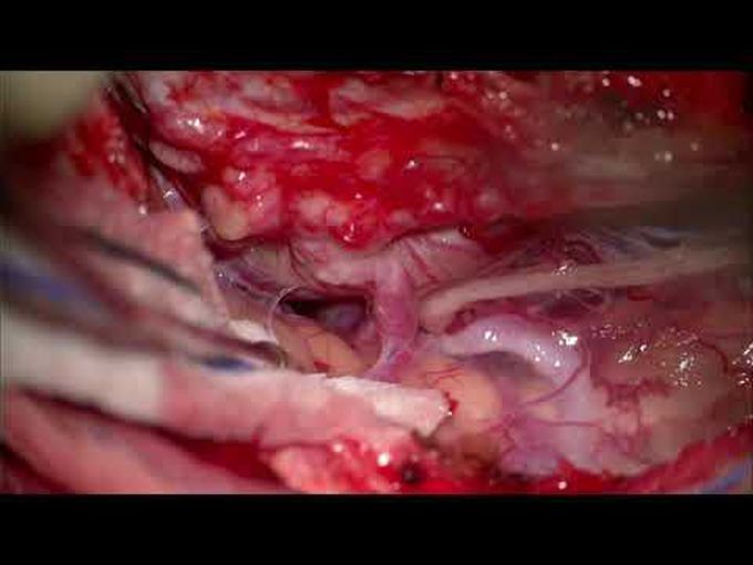 Right jugular foramen dural arteriovenous fistula Cognard IV