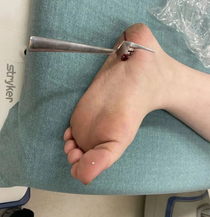 Puncture wound- Fork in the heel