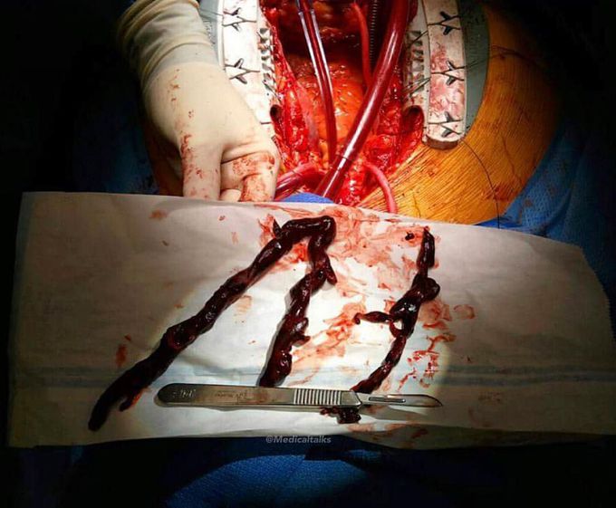 Massive pulmonary embolism