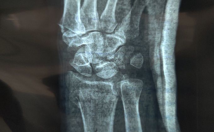 Fracture of Radius and Triquetrum