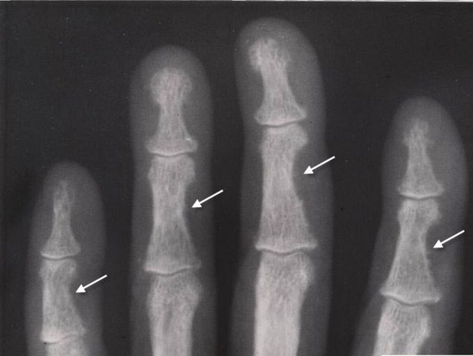 Hyperparathyroidisim