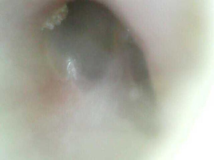 Benign lesion or cholesteatome ?