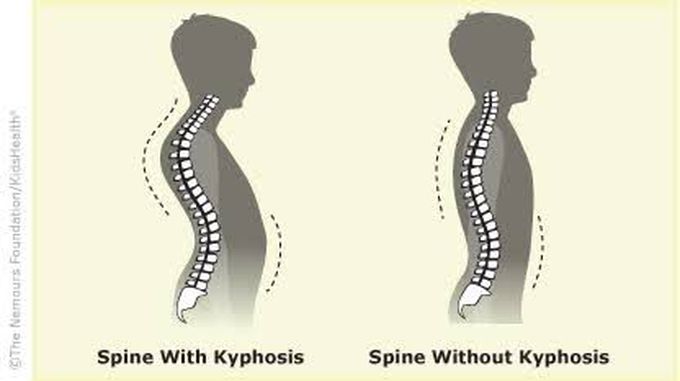 Causes of kyphosis in adults