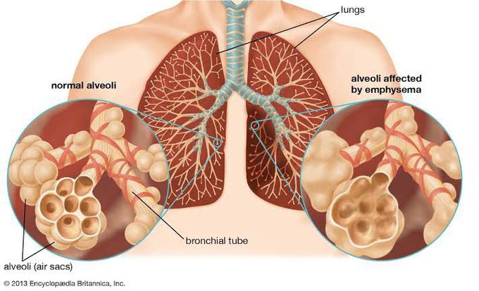 causes of emphysema