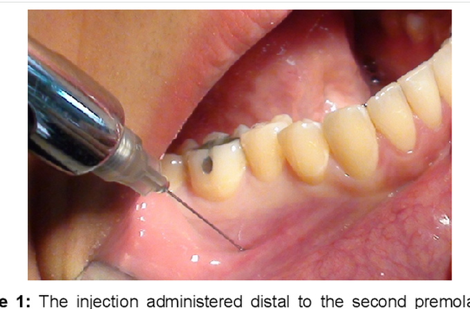 Mental nerve block