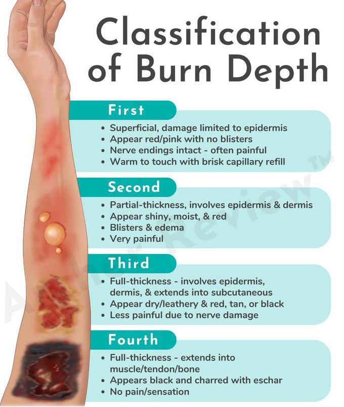 Classification of Burn Depth