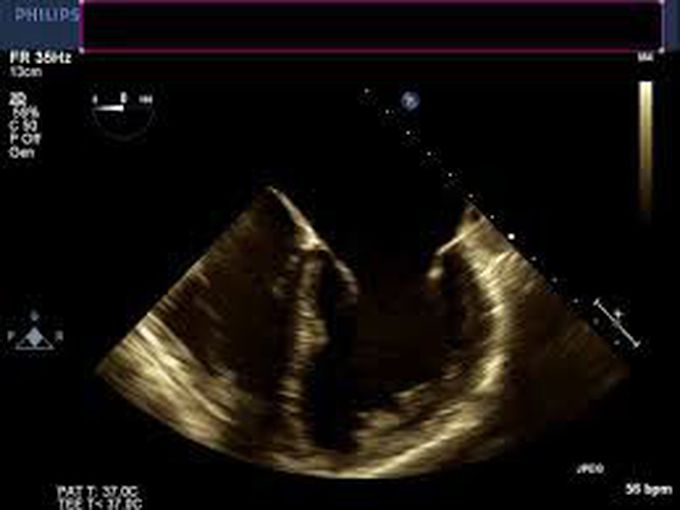 MRI of coronary artery  fistula