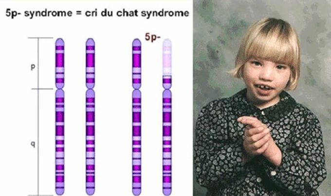 Cause of Cri-du-chat Syndrome