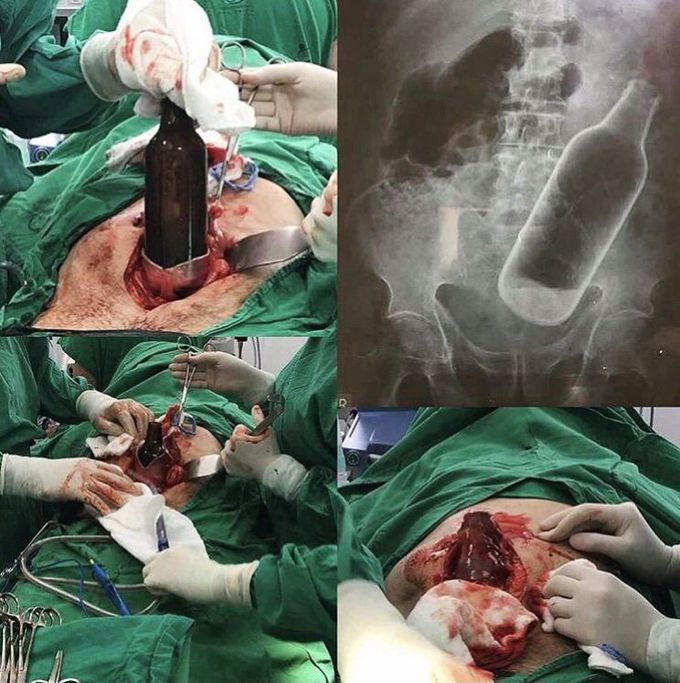 Beer bottle in rectum