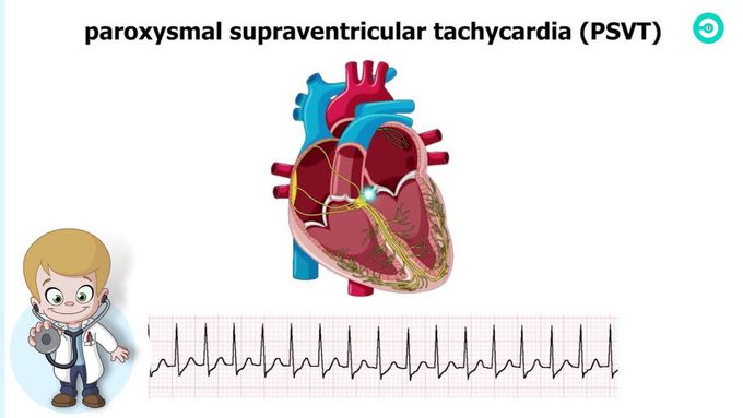 Types and ECG features of Supraventricular Tachycardia (SVT)