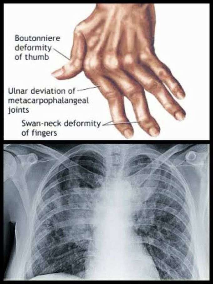 Symptoms of caplan syndrome