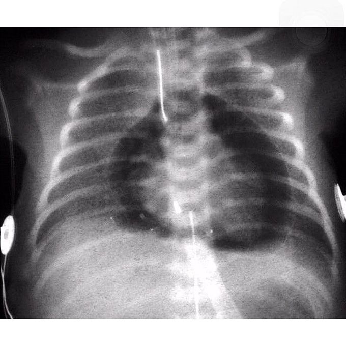 Pneumopericardium