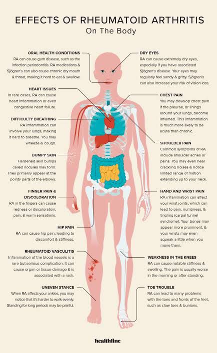 Symptoms of rheumatoid arthritis - MEDizzy