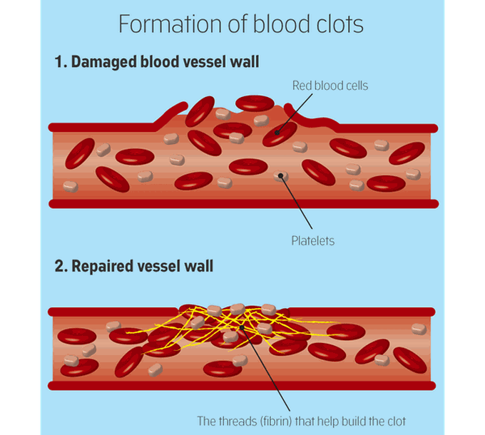 Blood clot