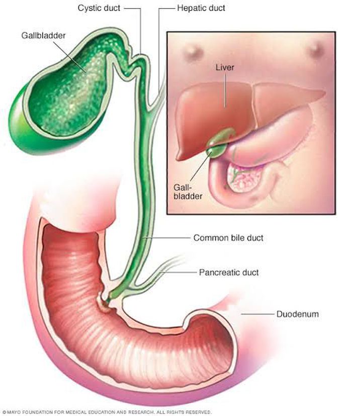 Cholecystitis