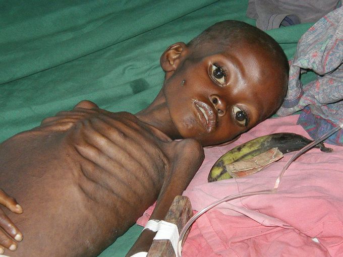 Marasmus: A Type of Protein Energy Malnutrition
