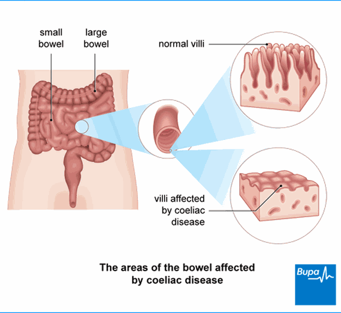 Causes of Coeliac disease
