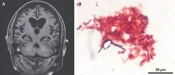 Nocardial Brain Abscesses