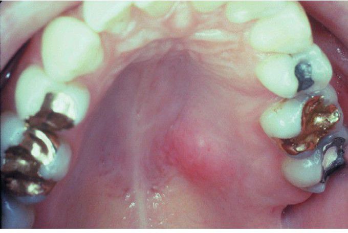 Necrotizing Sialometaplasia