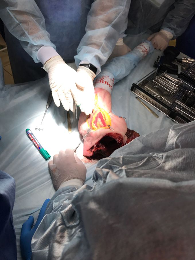 AOTRAUMA cadaver course dedicated to approaches for upper extremity