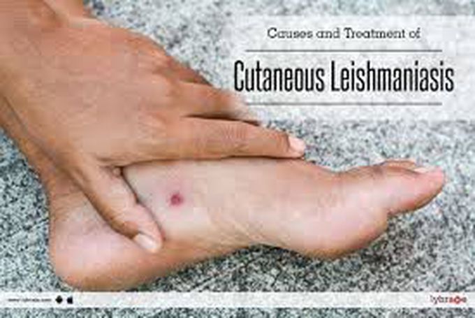 Treatment for leishmaniasis