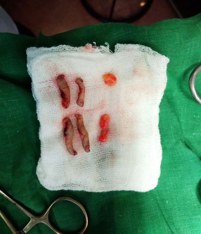 Upper Eyelid Surgery