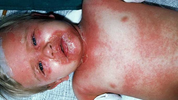 Scalded skin syndrome