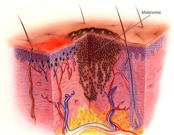 Melanoma