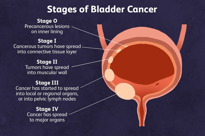 Stages of Bladder cancer