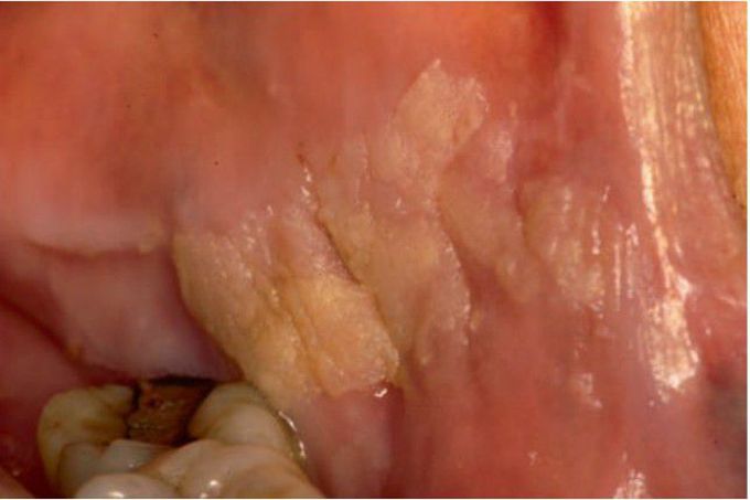 Hyperkeratosis of buccal mucosa